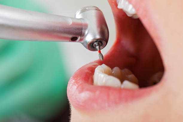 Best Emergency Wisdom Teeth Removal in Deforest, WI